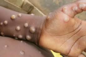 La variole du singe, déclarée urgence continentale en Afrique
